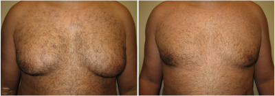 gynecomastia-surgeon-long-island-before-after-1-1