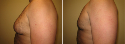 gynecomastia-surgeon-long-island-before-after-1-2