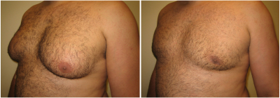 gynecomastia-surgeon-long-island-before-after-1-3