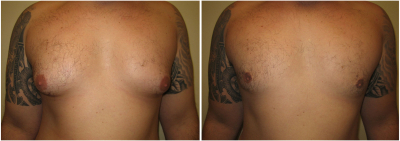 gynecomastia-surgeon-long-island-before-after-10-1