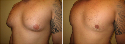 gynecomastia-surgeon-long-island-before-after-10-3