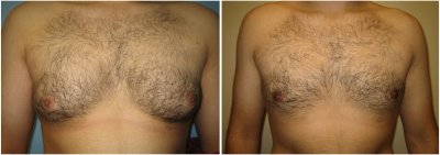 gynecomastia-surgeon-long-island-before-after-11-1