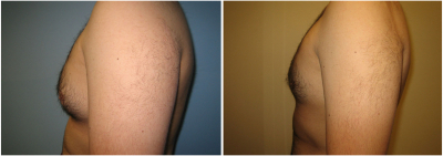 gynecomastia-surgeon-long-island-before-after-11-2