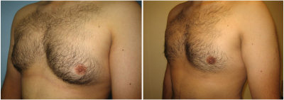 gynecomastia-surgeon-long-island-before-after-11-3