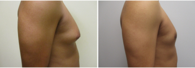 gynecomastia-surgeon-long-island-before-after-12-3