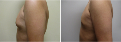 gynecomastia-surgeon-long-island-before-after-13-2