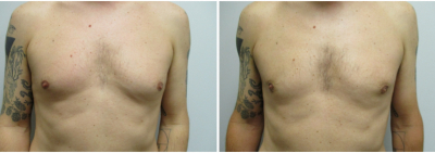 gynecomastia-surgeon-long-island-before-after-14-1