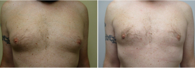 gynecomastia-surgeon-long-island-before-after-15-1