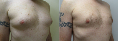 gynecomastia-surgeon-long-island-before-after-15-2