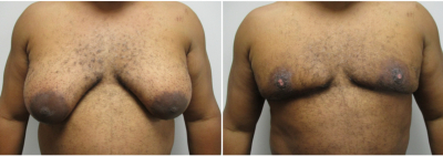 gynecomastia-surgeon-long-island-before-after-16-1