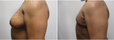 gynecomastia-surgeon-long-island-before-after-16-2