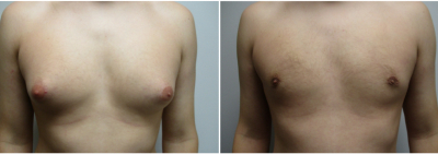 gynecomastia-surgeon-long-island-before-after-17-1