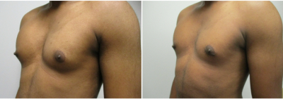 gynecomastia-surgeon-long-island-before-after-18-2