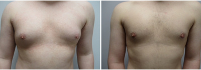 gynecomastia-surgeon-long-island-before-after-19-1