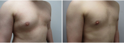 gynecomastia-surgeon-long-island-before-after-19-3