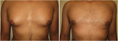 gynecomastia-surgeon-long-island-before-after-2-1