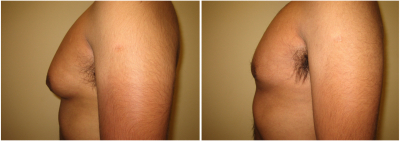 gynecomastia-surgeon-long-island-before-after-2-2