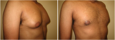 gynecomastia-surgeon-long-island-before-after-2-3