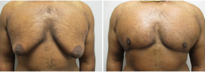 gynecomastia-surgeon-long-island-before-after-21-1