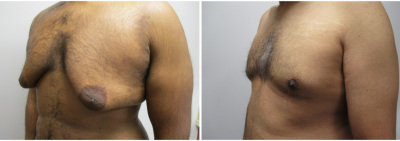 gynecomastia-surgeon-long-island-before-after-21-2