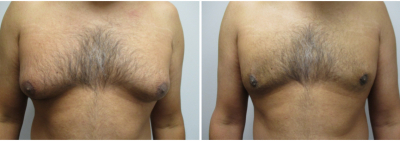 gynecomastia-surgeon-long-island-before-after-23-1