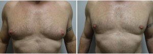 gynecomastia-surgeon-long-island-before-after-24-1