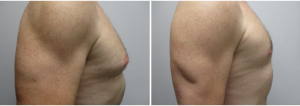 gynecomastia-surgeon-long-island-before-after-24-3