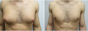 gynecomastia-surgeon-long-island-before-after-26-1