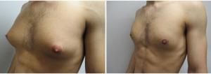 gynecomastia-surgeon-long-island-before-after-26-2