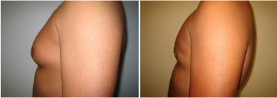 gynecomastia-surgeon-long-island-before-after-3-2