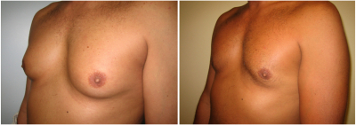 gynecomastia-surgeon-long-island-before-after-3-3