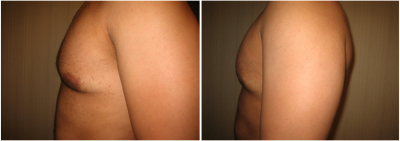 gynecomastia-surgeon-long-island-before-after-5-2