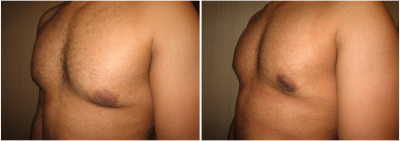 gynecomastia-surgeon-long-island-before-after-5-3