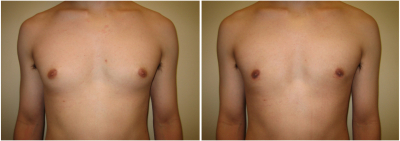 gynecomastia-surgeon-long-island-before-after-6-1