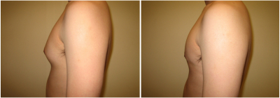 gynecomastia-surgeon-long-island-before-after-6-2