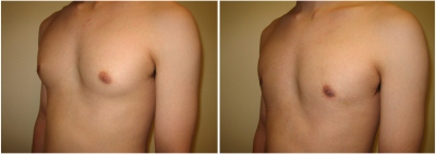 gynecomastia-surgeon-long-island-before-after-6-3