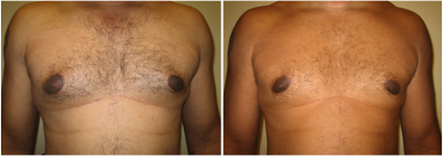 gynecomastia-surgeon-long-island-before-after-7-1