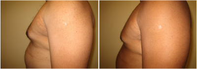 gynecomastia-surgeon-long-island-before-after-7-2