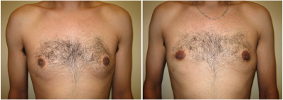 gynecomastia-surgeon-long-island-before-after-9-1