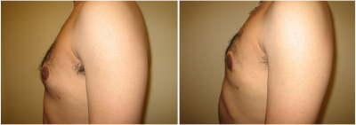 gynecomastia-surgeon-long-island-before-after-9-2