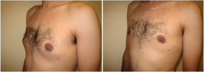 gynecomastia-surgeon-long-island-before-after-9-3