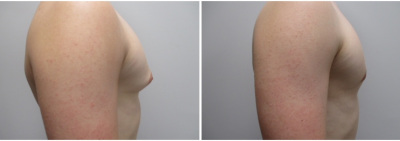 gynecomastia-surgeon-long-island-before-after-20-2