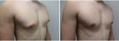 gynecomastia-surgeon-long-island-before-after-20-3