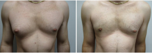 gynecomastia-surgeon-long-island-before-after-28-1