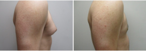 gynecomastia-surgeon-long-island-before-after-28-2