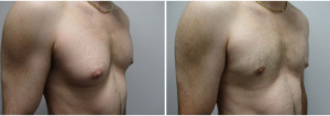 gynecomastia-surgeon-long-island-before-after-28-3